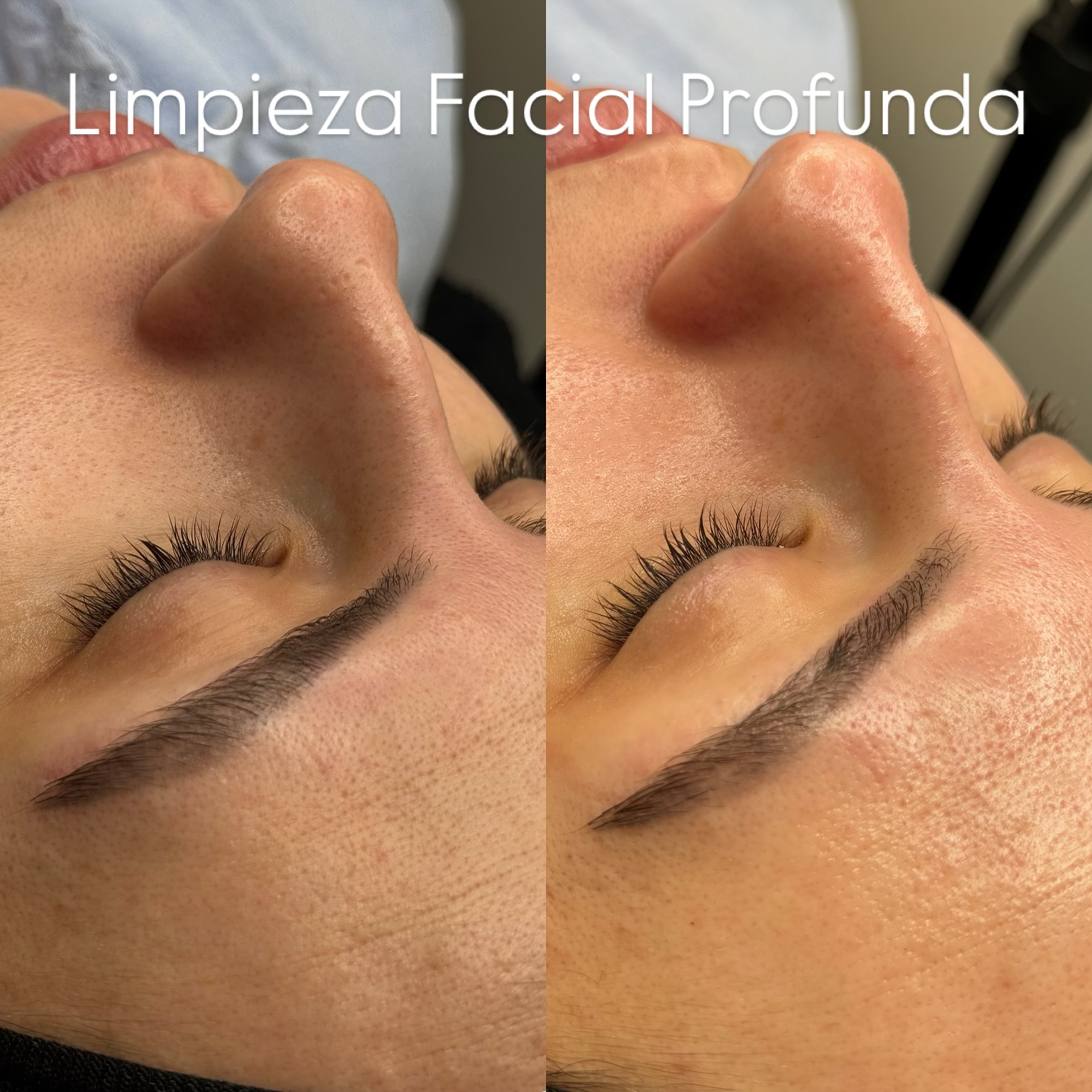 limpieza facial profunda